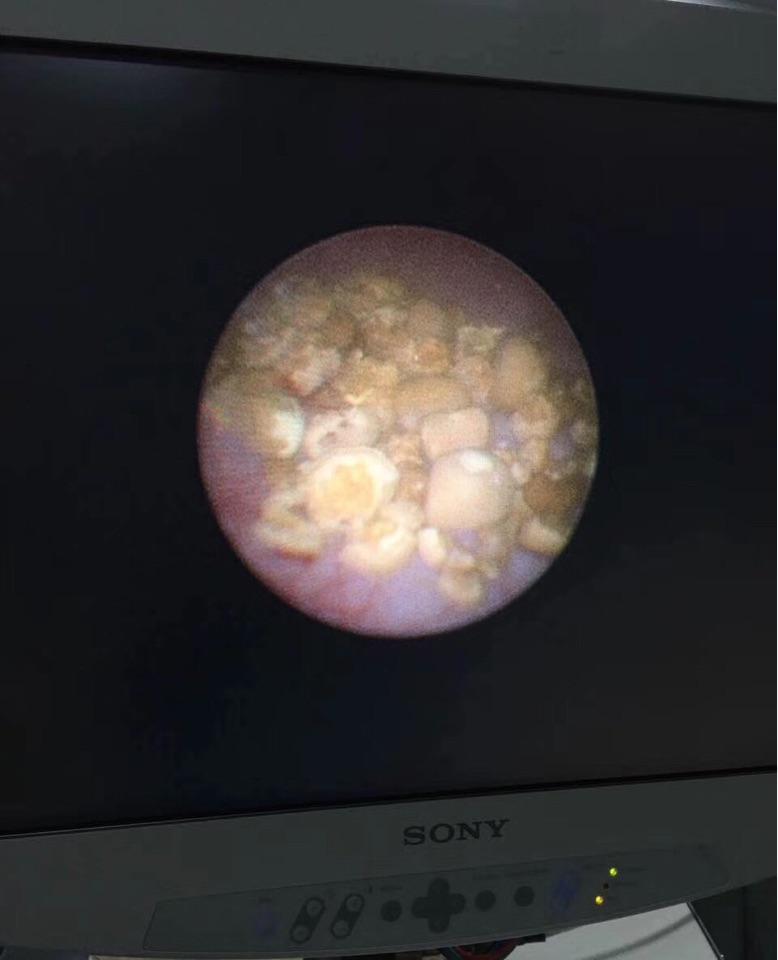 膀胱结石长什么样什么原因导致的有什么症状需要如何治疗呢