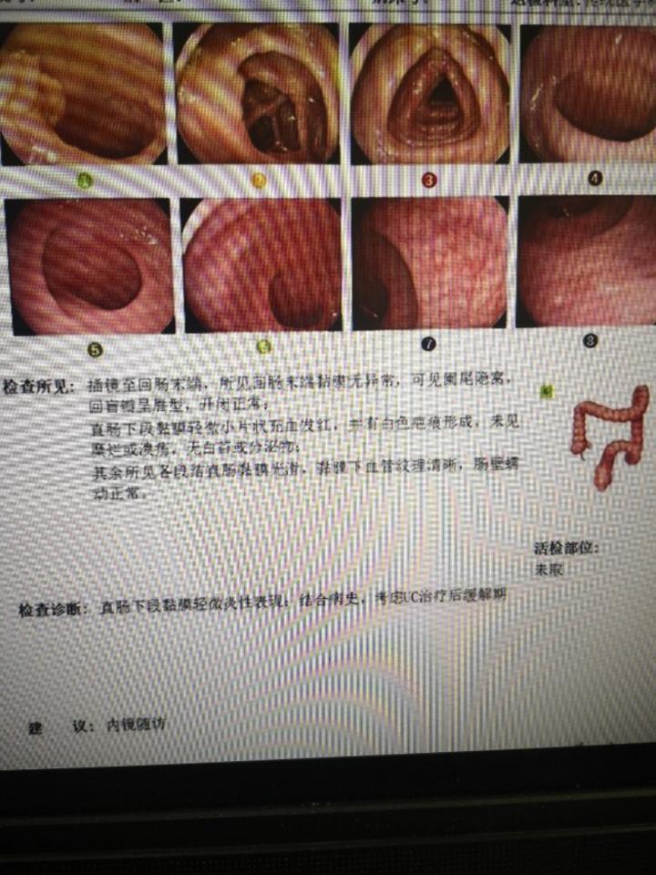 青玉散治疗慢性复发型溃疡性直肠炎