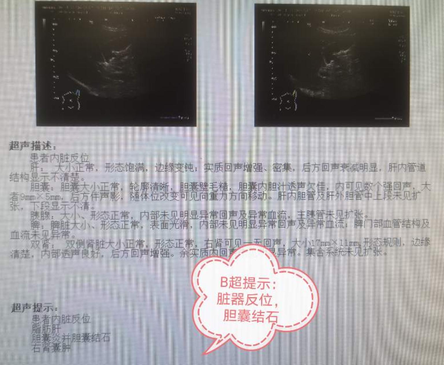 罕见的病例全脏器反位胆囊结石患者顺利完成微创胆囊手术