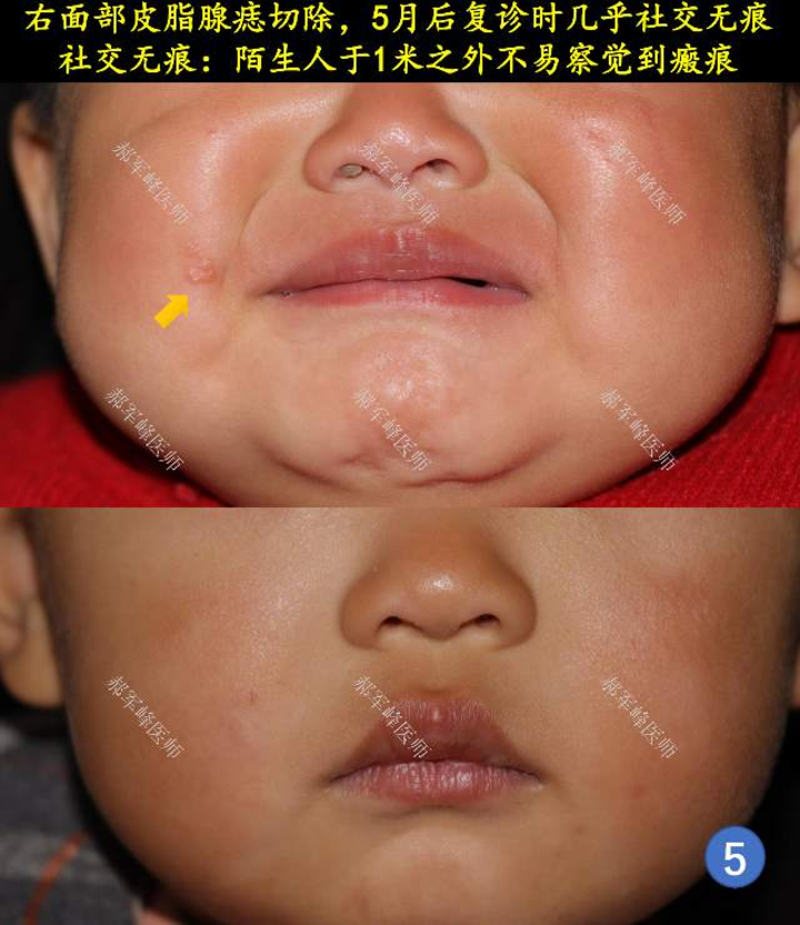 皮脂腺痣及其治疗方法 - 微医(挂号网)