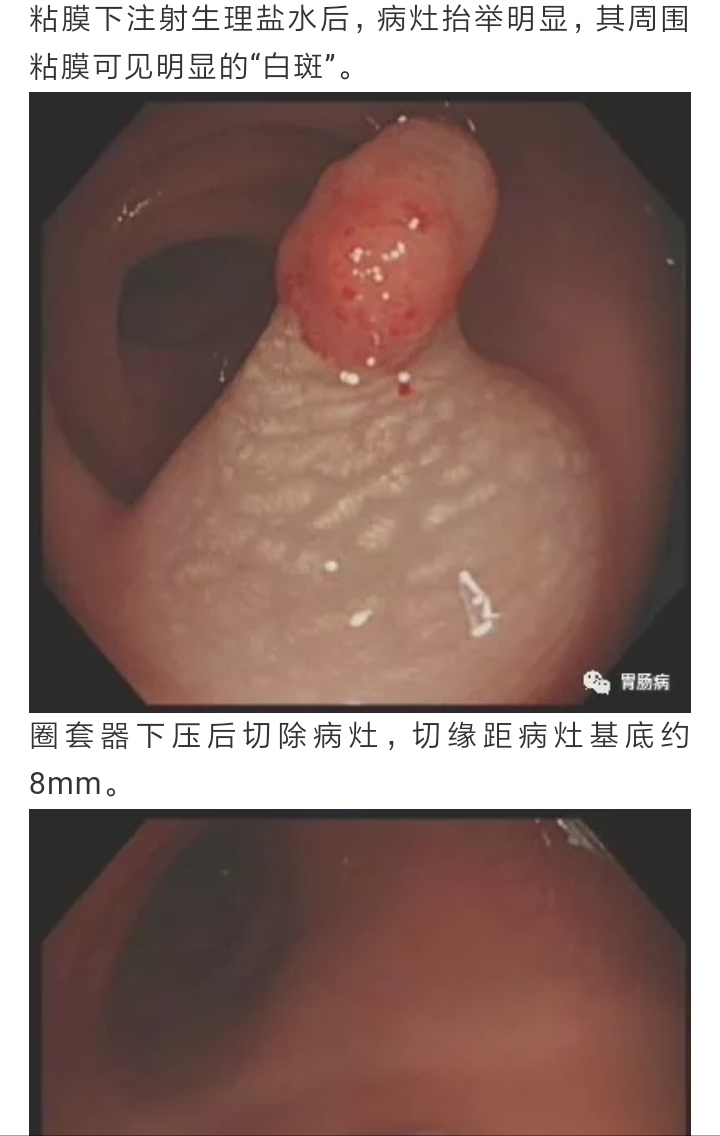 两个真实病例告诉你人过40无症状也要做个肠镜