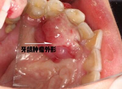 牙龈瘤图片 手术图片
