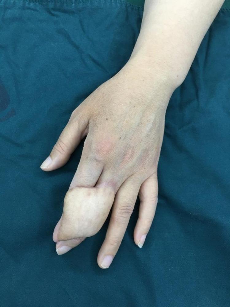 左手食中指热压伤皮瓣修复及分指术后 - 微医(挂号网)