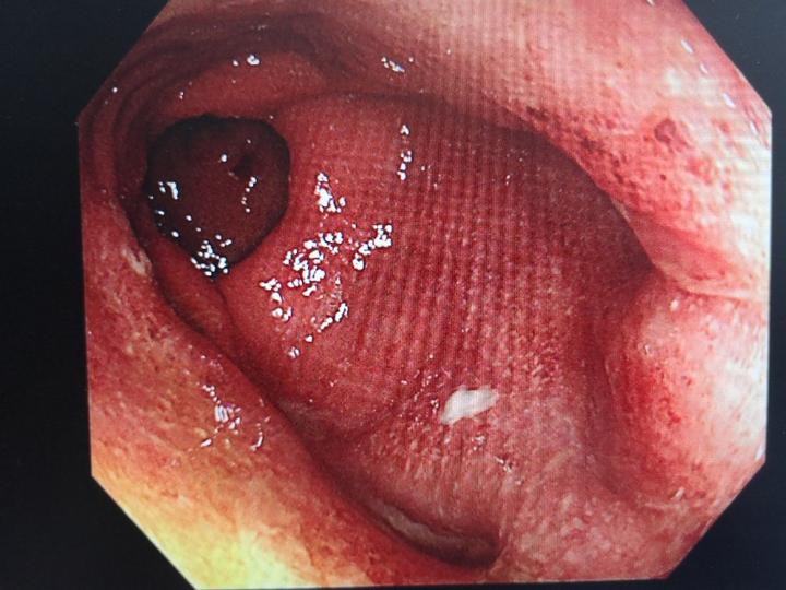 青玉散治療復發型直腸型潰瘍性結腸炎也有效