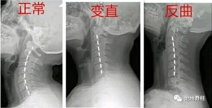 颈椎生理曲度变直还能恢复吗