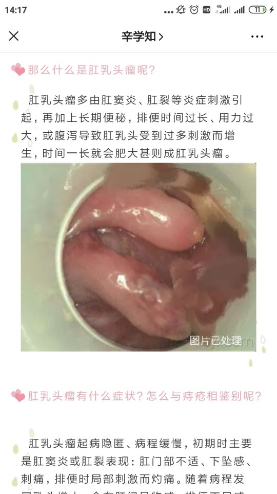 肛门长瘤子图片图片