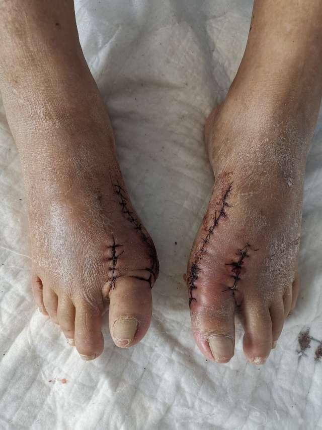 拇外翻大脚骨手术矫治术