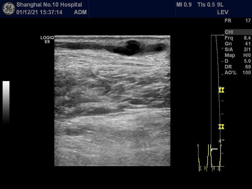 原创超声引导下肢大隐静脉曲张硬化治疗