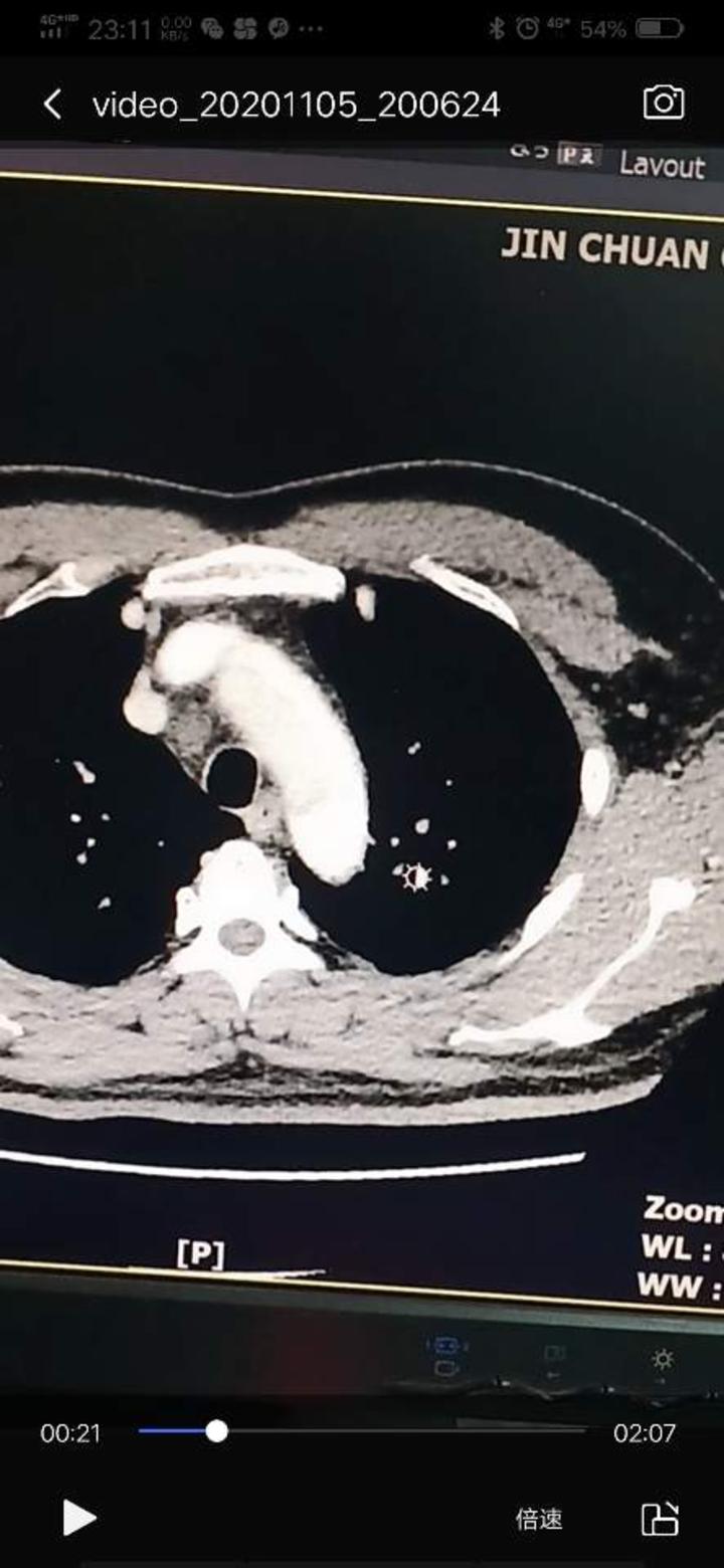 主动脉夹层增强ct影像资料,.