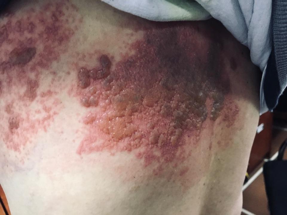 带状疱疹的特点