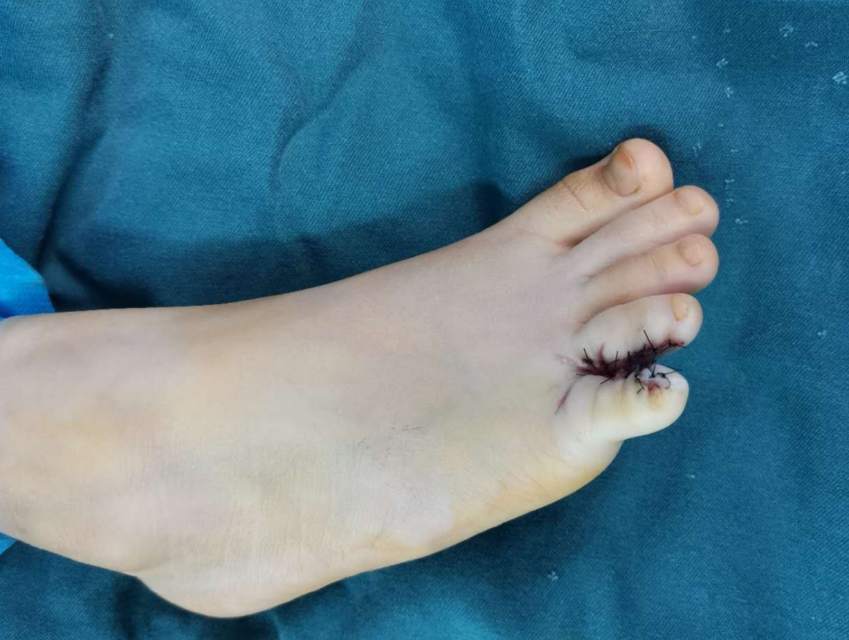 了解一下足部并指畸形及如何手术治疗