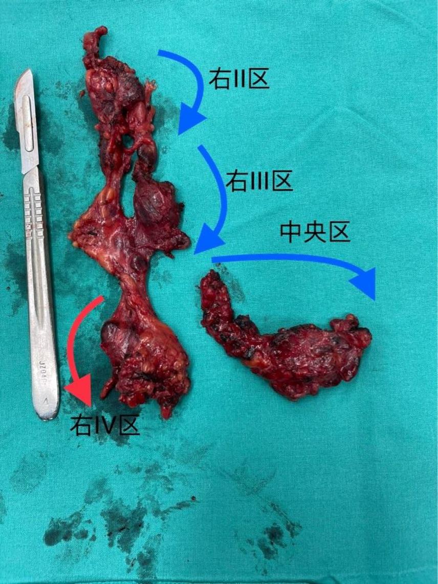 20岁女性甲状腺乳头癌广泛淋巴结转移 - 微医(挂号网)