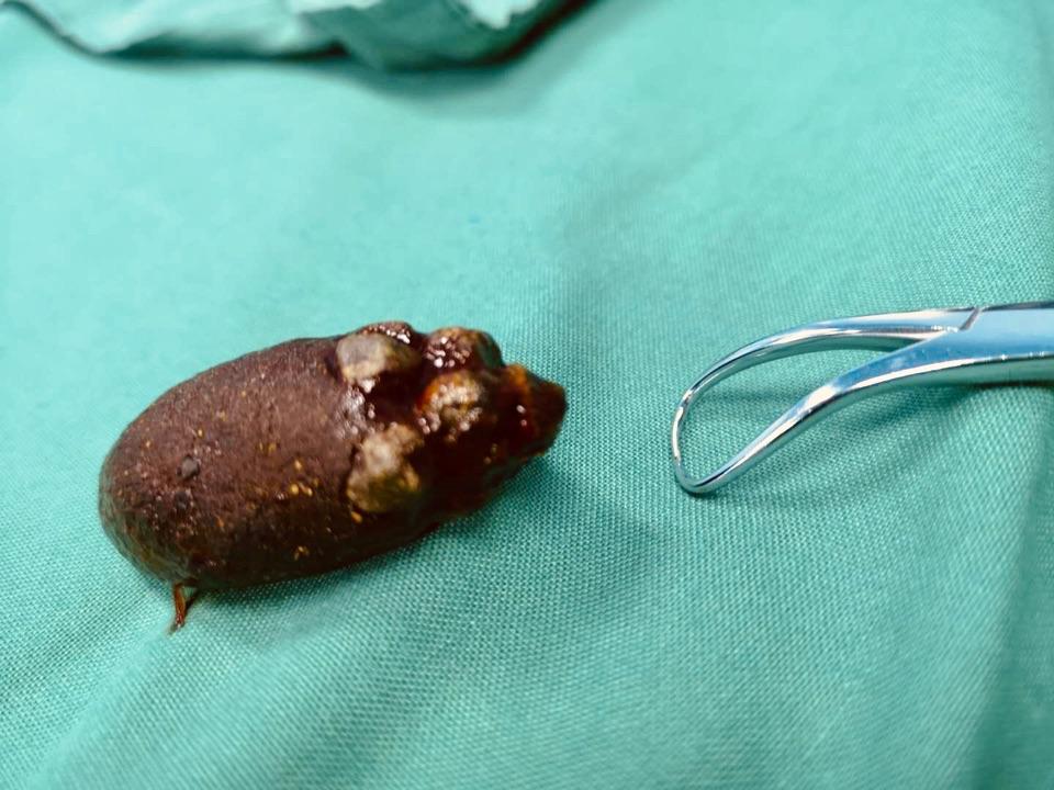 胆囊里边竟然也有只"小老鼠"? - 微医(挂号网)