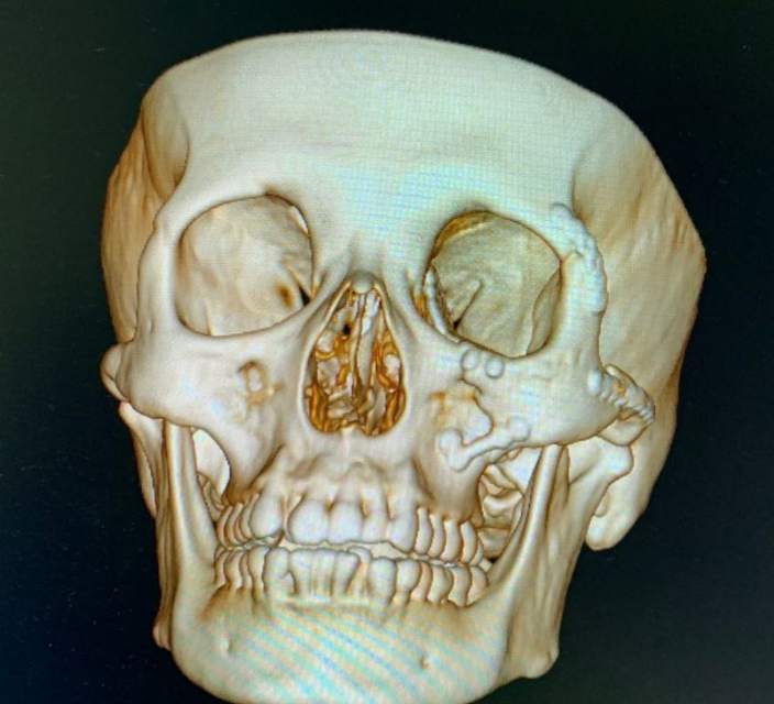 一例眶颧颌骨折的案例