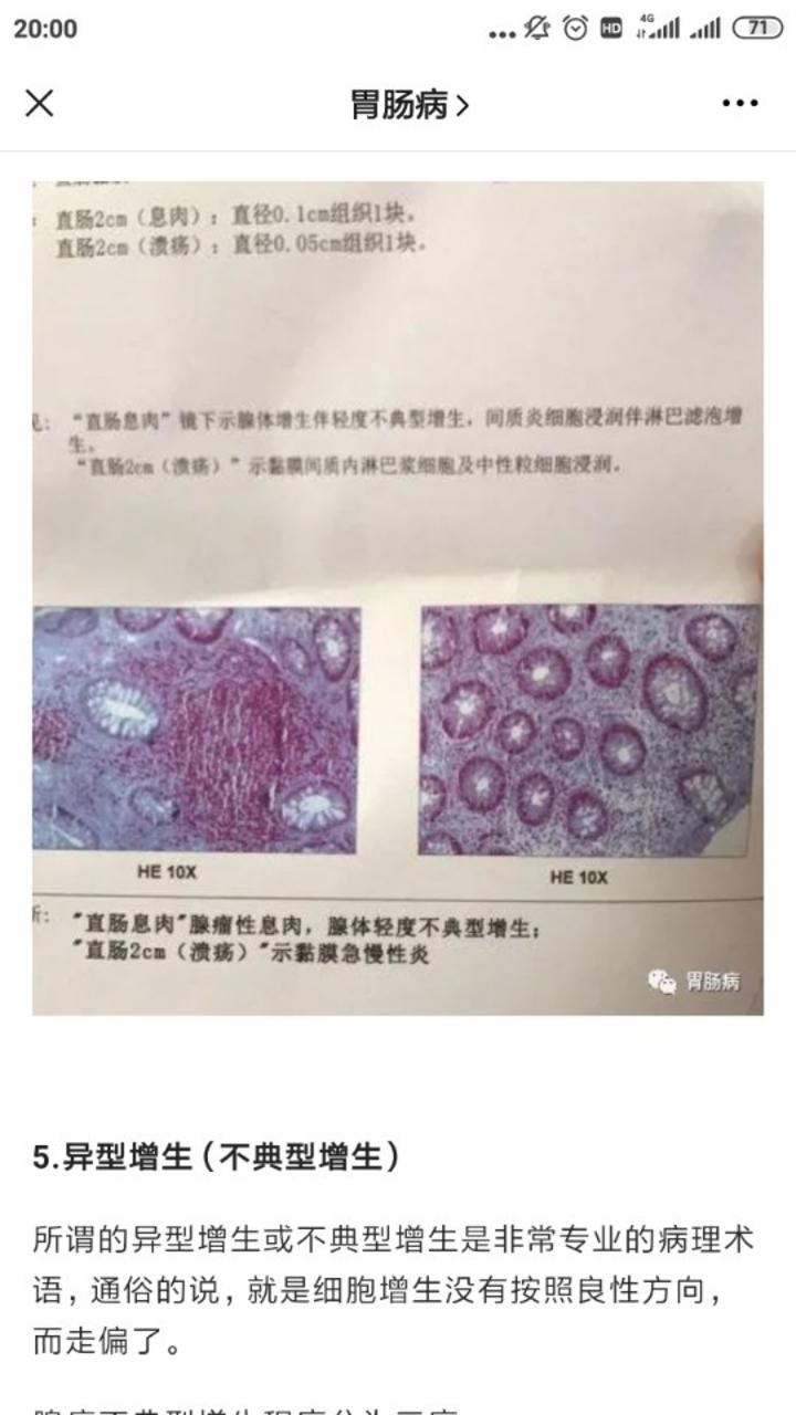 关于大肠息肉肠镜病理报告中的专业词到底是啥意思