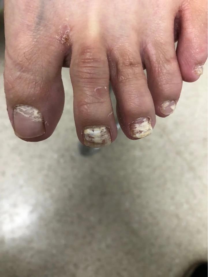 如何判断自己有没有灰指甲?_帅茂圣医生文章_泰州市人民医院北院-微医