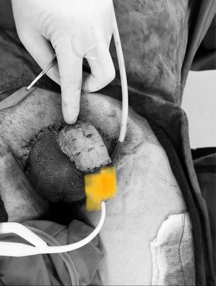 手术工作日志23怎样预防阴囊湿疹样癌阴囊paget病