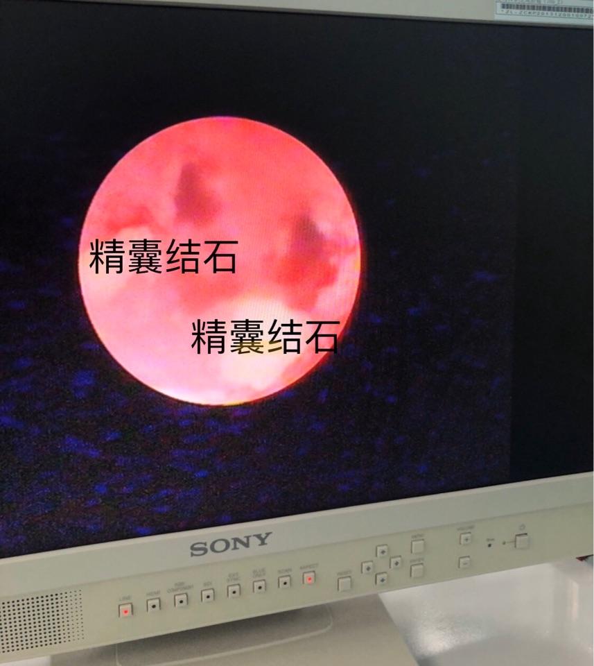 男科手术探秘1血精精囊炎和精囊镜手术