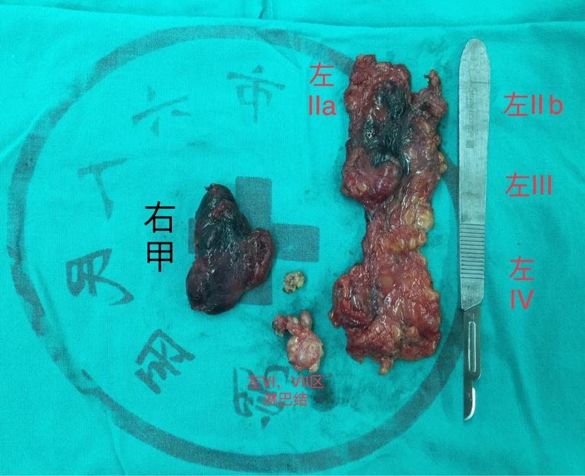 年轻女性甲状腺癌术后10年淋巴结广泛转移