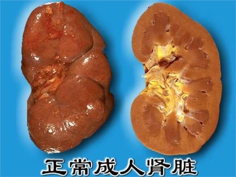 人体肾脏的沉默杀手