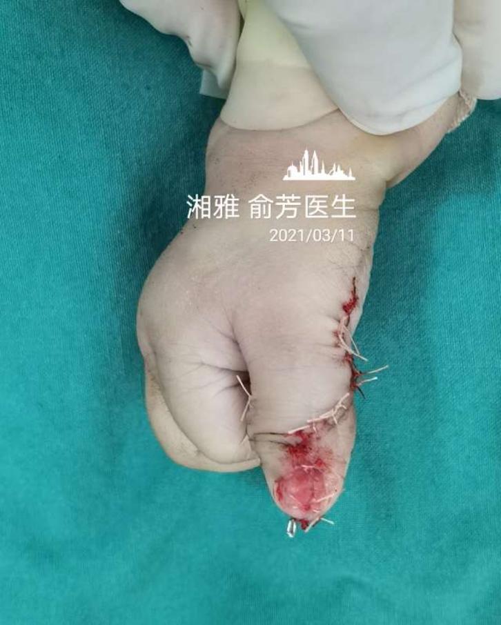 蟹钳样畸形,是目前复拇指畸形里比较复杂的一种,不过