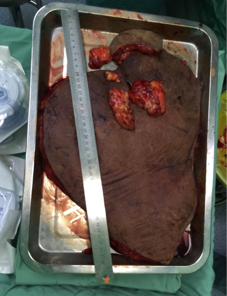 成功切除一例巨大神经纤维瘤