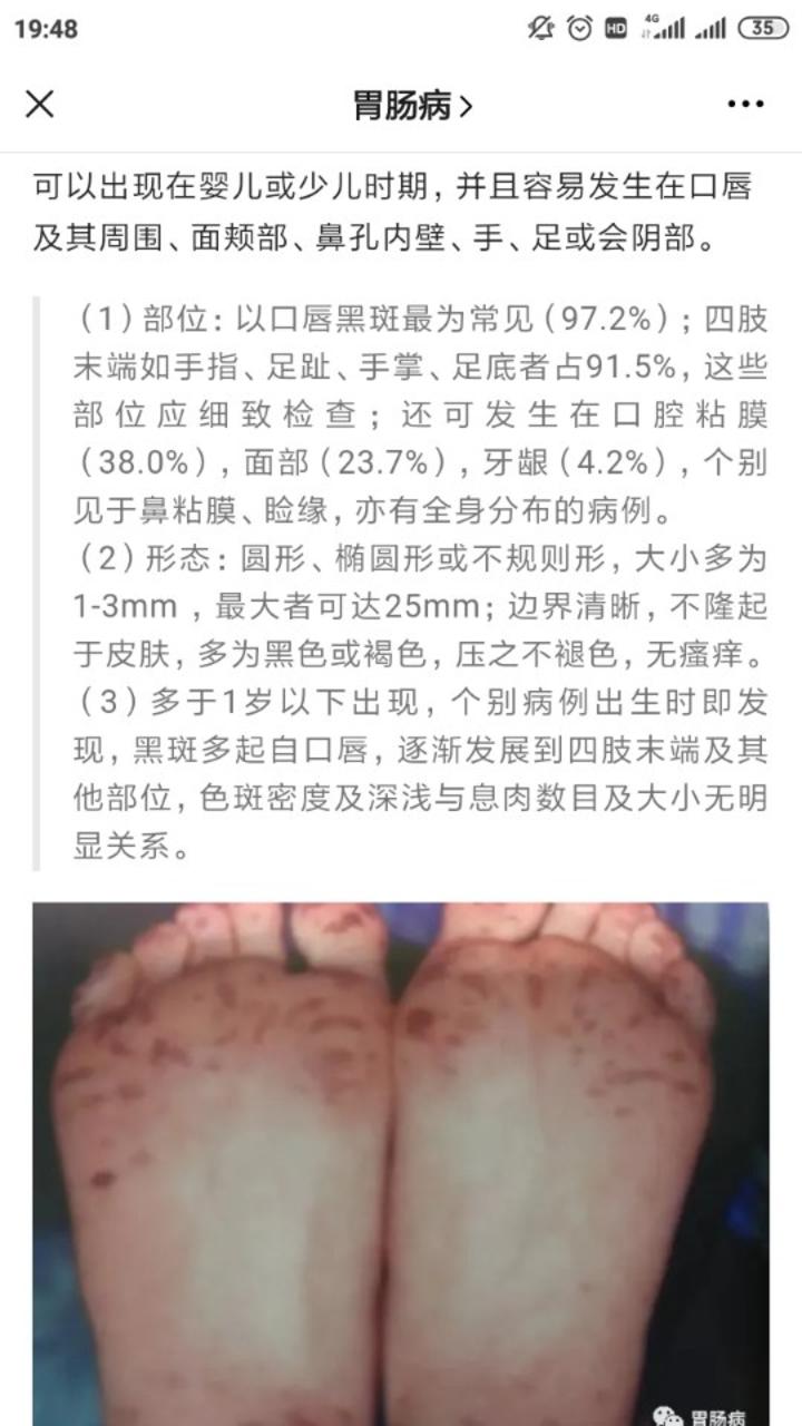 嘴上手上長黑斑要警惕癌變風險極高的黑斑息肉綜合徵pjs