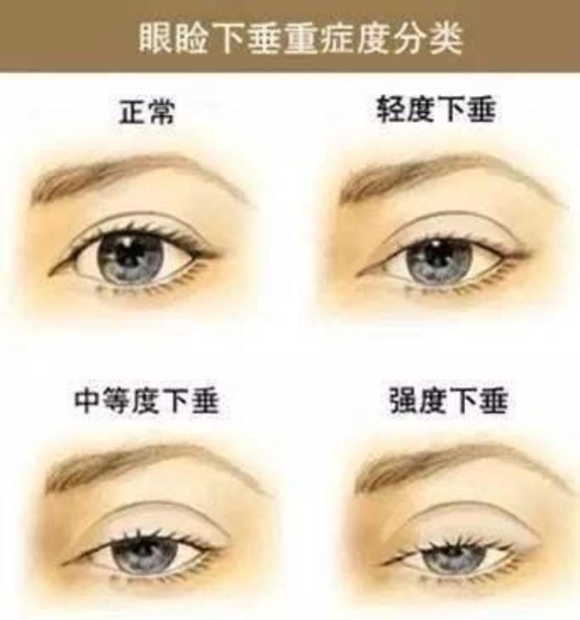 上睑下垂需要做上睑下垂矫正手术,而上睑松弛只要在切开双眼皮时适当