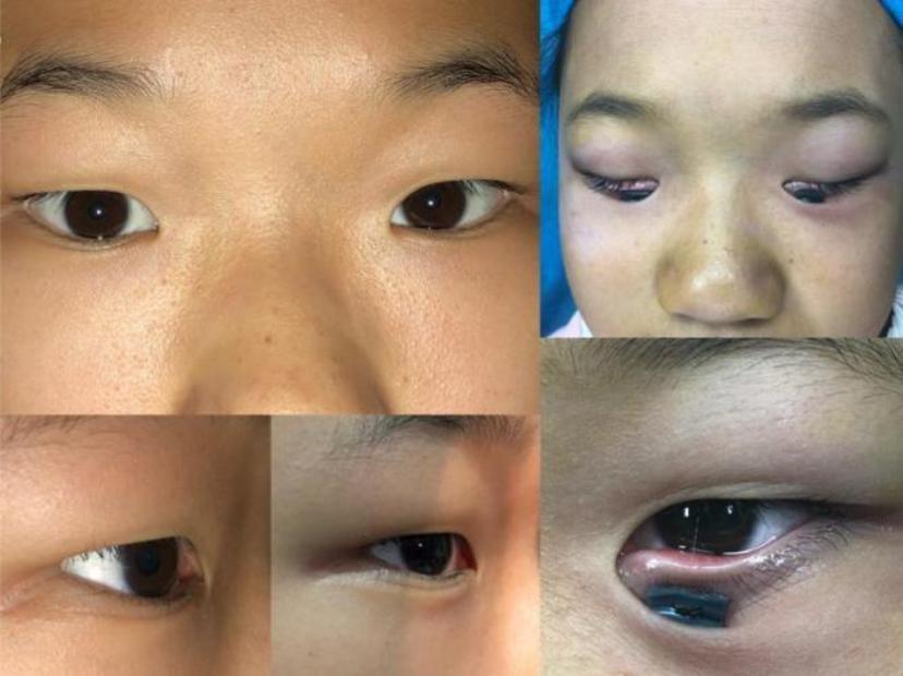 许多合并内眦赘皮,塌鼻梁的孩子,往往存在下睑内翻,倒睫.