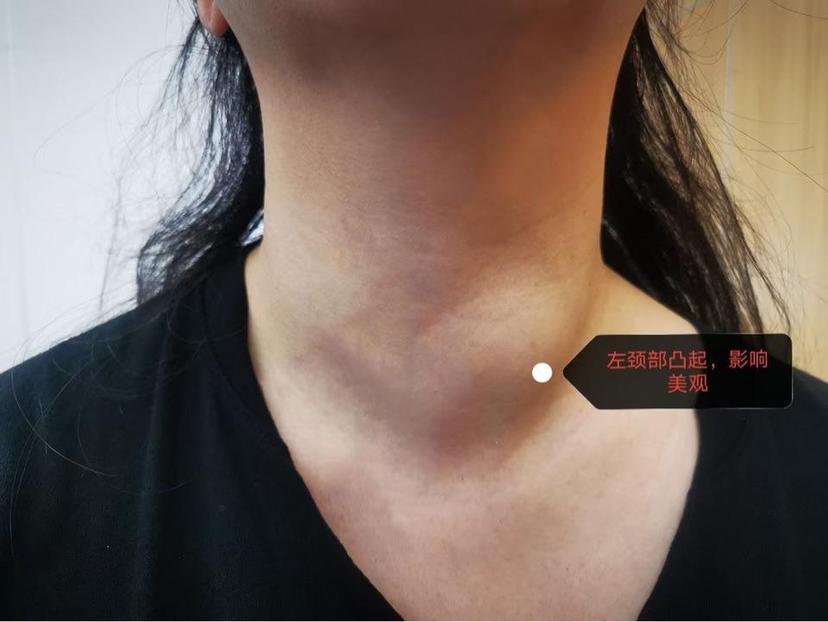 超声引导甲状腺囊肿硬化治疗