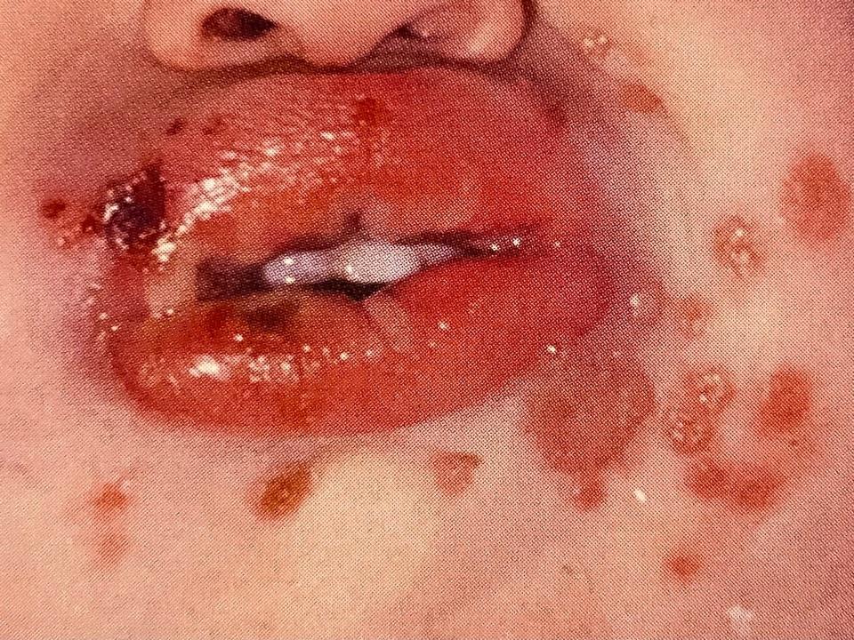 儿童常见口腔黏膜疾病疱疹性龈口炎
