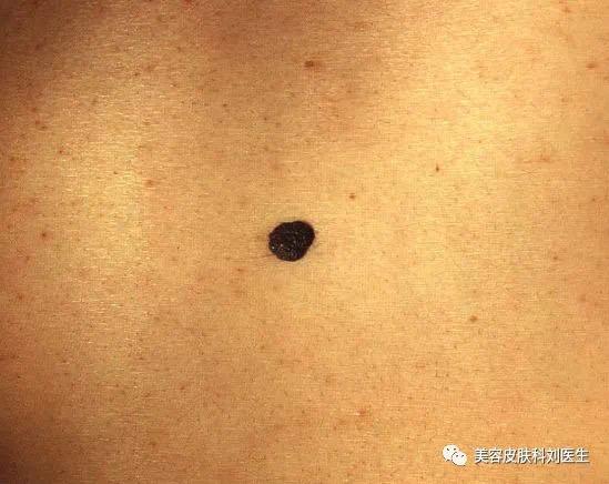 色素痣有哪些分类如何治疗