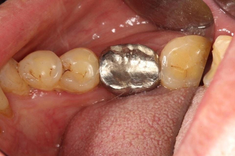 图1: 金属全冠,牙床红肿,牙周袋形成患者冷某,女,45岁