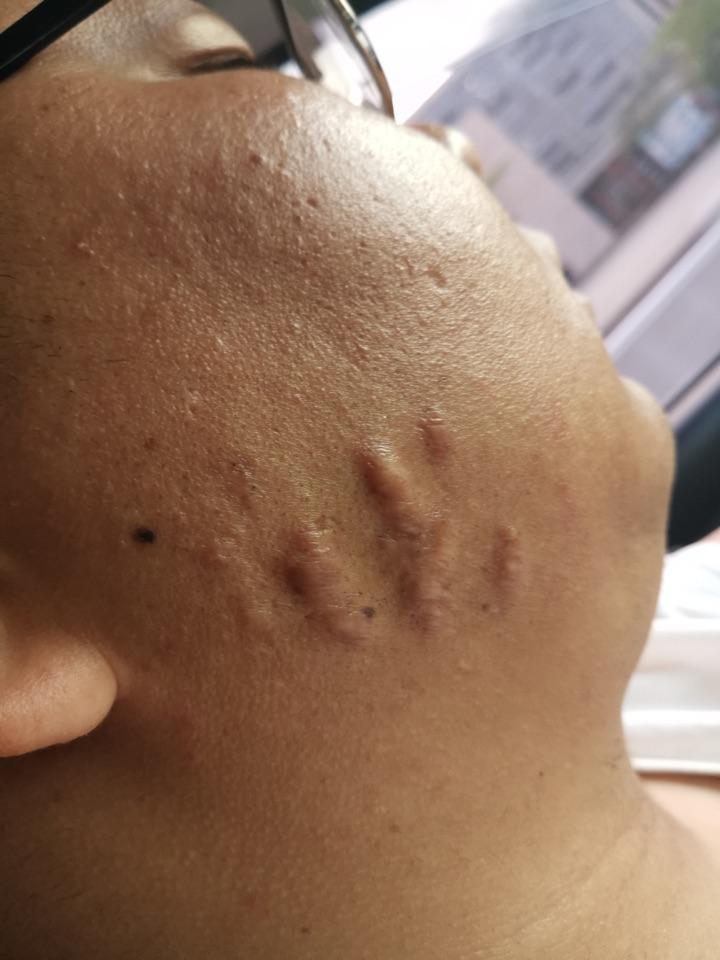 身上的疤痕怎么办