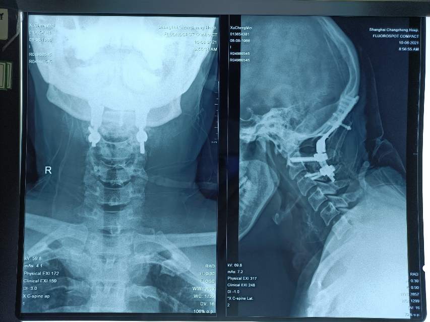 罕见病例颅底凹陷先天性寰椎枕骨化