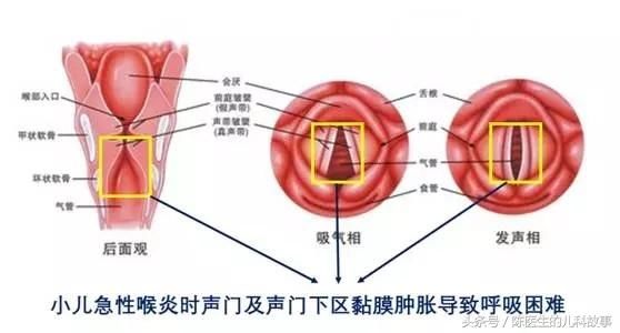 经上述处理仍有严重缺氧征象或有皿度以上喉梗阻者,应及时行气管切开