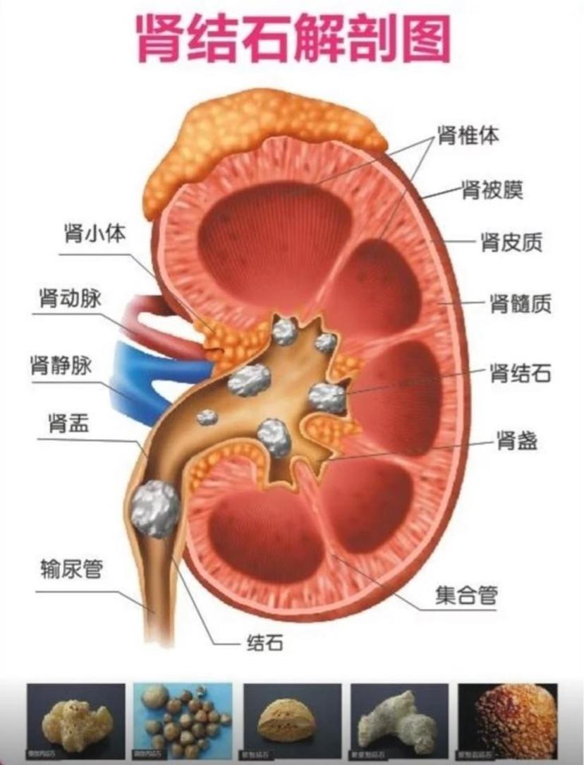 又遇肾结石_罗华荣医生文章_上海市同济医院-微医