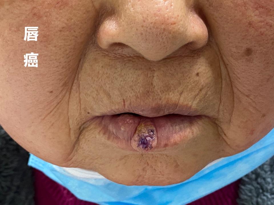 口腔癌:是指发生于口腔黏膜的恶性肿瘤的总称,病理