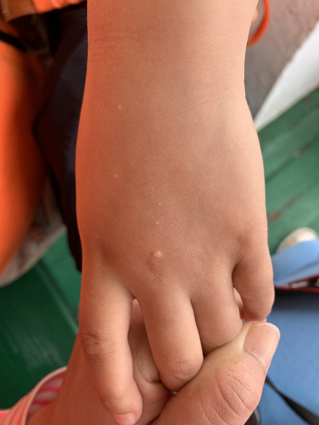 宝宝五岁起了一些白色的泡泡