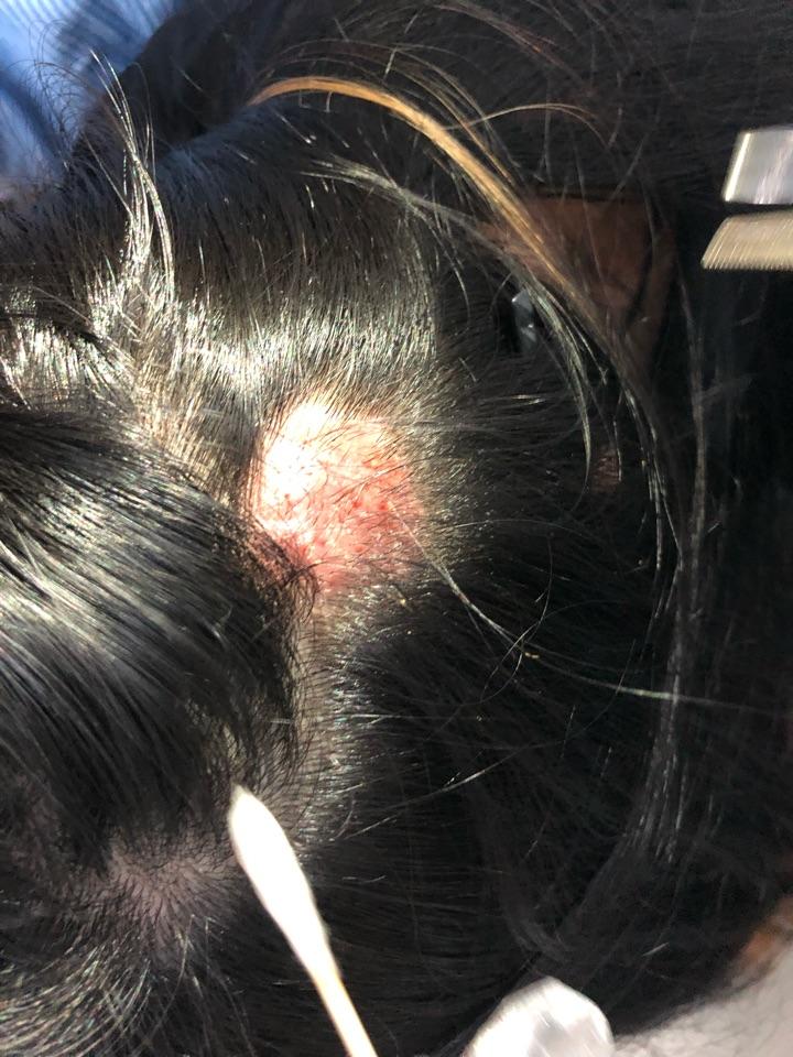 儿童头皮皮疹伴脱发多发性脓肿伴脱发要注意头癣的可能