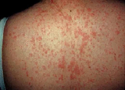 临床总结:常见的发热伴皮疹性皮肤病 