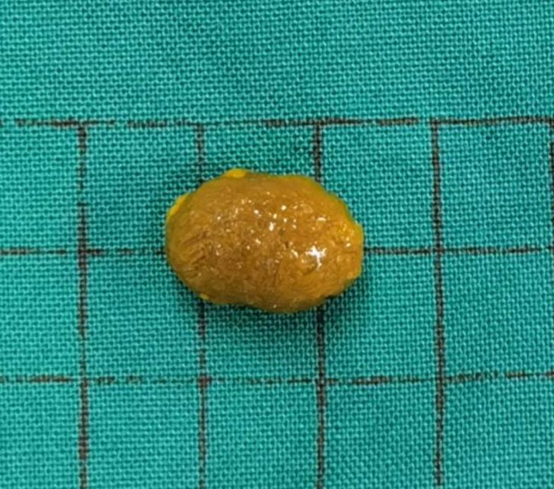 单颗胆囊胆固醇性结石最适合保胆取石