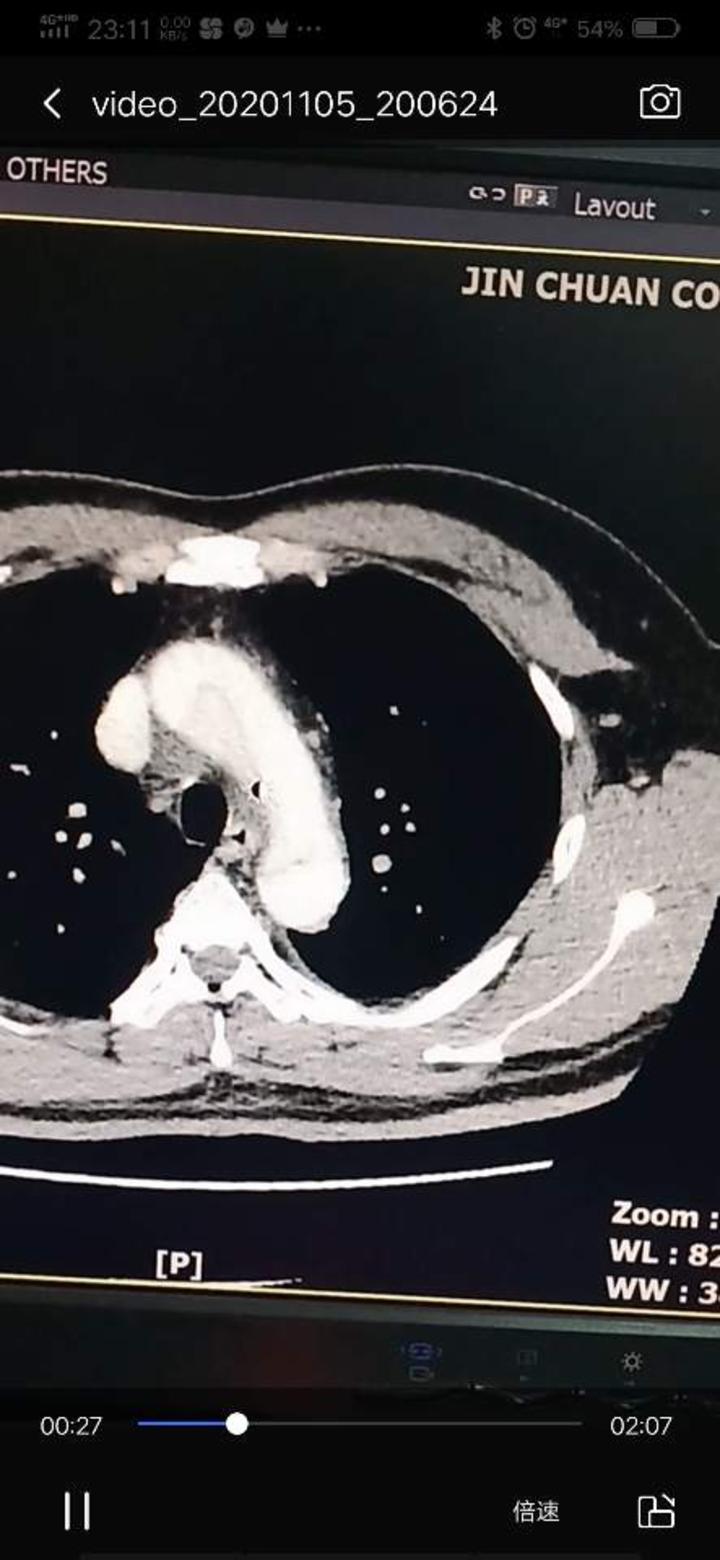 主动脉夹层增强ct影像资料,.