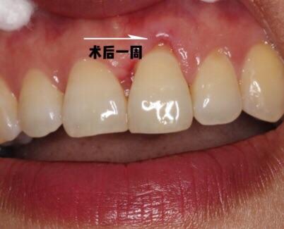 牙龈瘤微创摘除3例