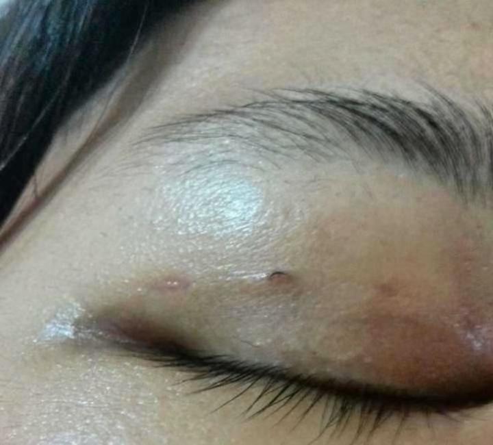 双眼皮埋线线头外露可以自己剪掉吗