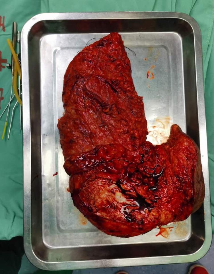 成功切除一例巨大神经纤维瘤