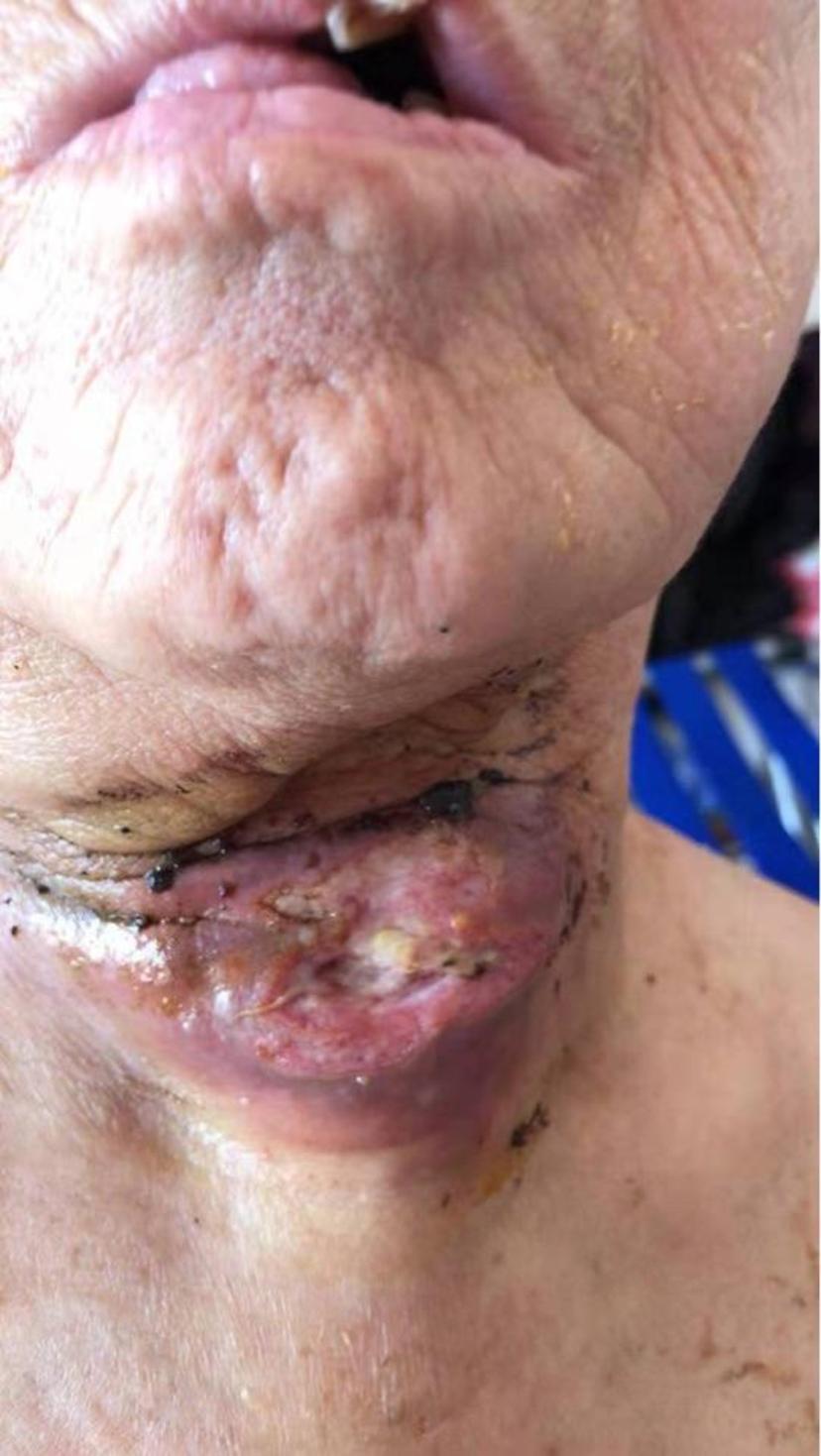 中医治疗肿瘤不只是扶正