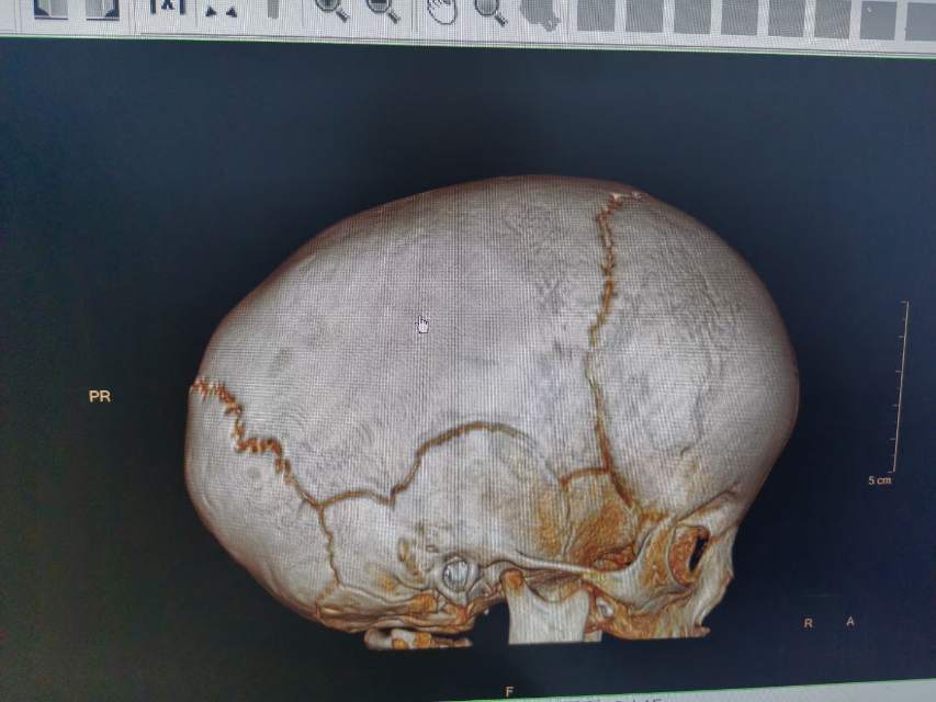 矢状缝早闭引起的长头畸形
