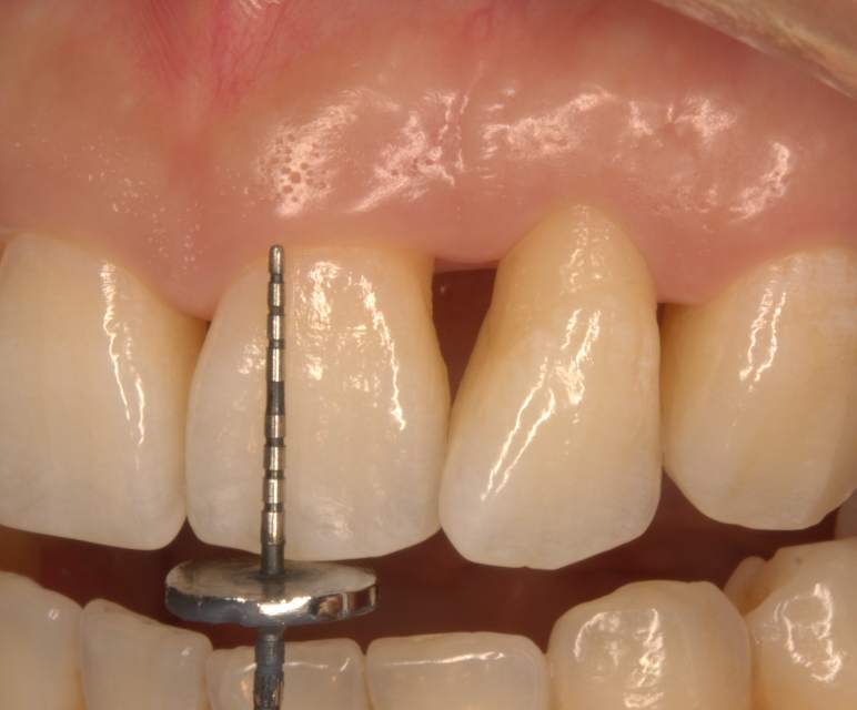 坚持不懈牙龈乳头基本恢复