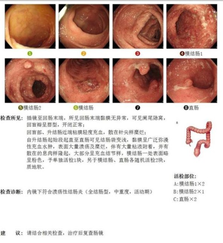 青玉散成功治愈中重度全结肠型溃疡性结肠炎又一例
